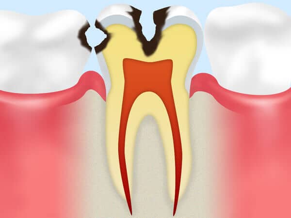 象牙質の虫歯