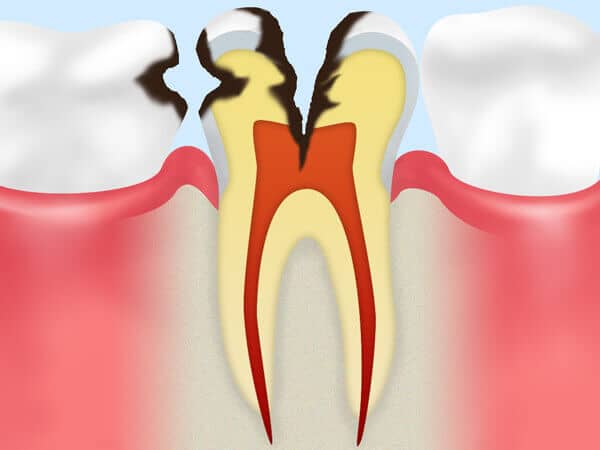 神経にまで達した虫歯