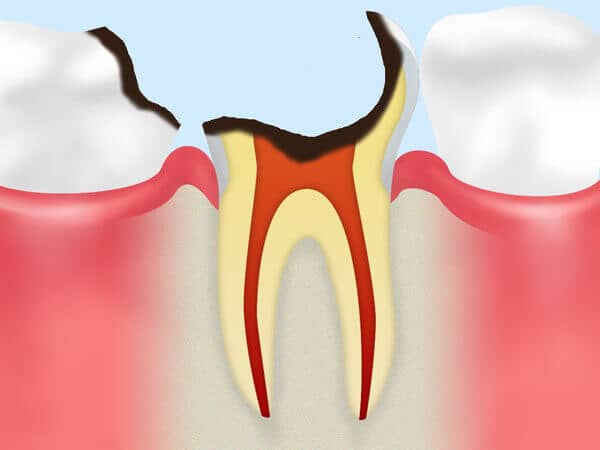 神経が死んでしまった虫歯