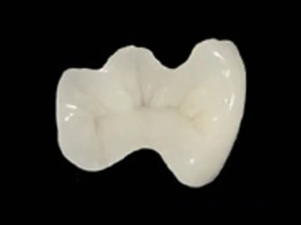 e-maxセラミックインレー