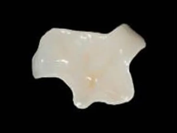 ジルコニアセラミックインレー