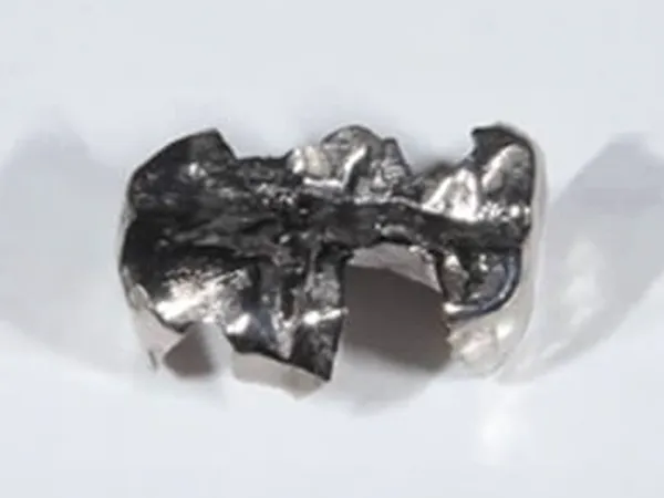 メタルインレー