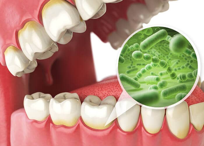 2. 歯周病の予防