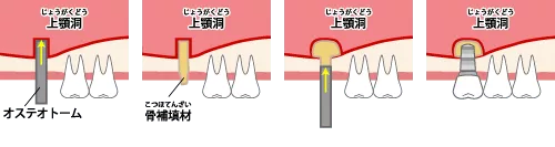 ソケットリフトとは、歯が生えていた部分からアプローチする骨造成法です。骨の高さが不足している部位に人工骨や自家骨を移植して、インプラント体を安全に埋入できる状態を確保します。サイナスリフトと比べると傷口が小さく、処置にかかる時間も短いことから、痛みや腫れなどの症状も少ない施術法といえます。