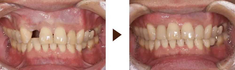  前歯へのインプラント治療