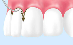 歯石の付着した歯の画像