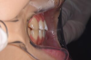 出っ歯の症例の治療後
