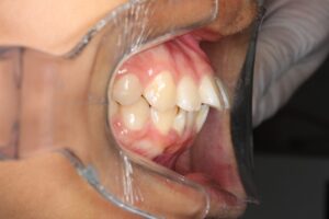 出っ歯の症例写真